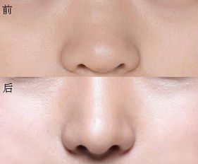 鼻翼整形术手术后的护理有哪些