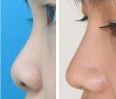 做鼻翼缩小手术前需要注意有哪些