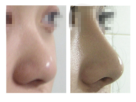 鼻尖整形手术的禁忌症