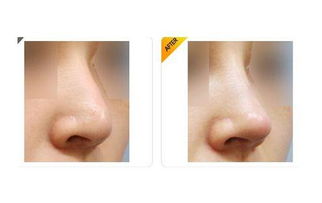 鼻尖整形的适合人群有哪些