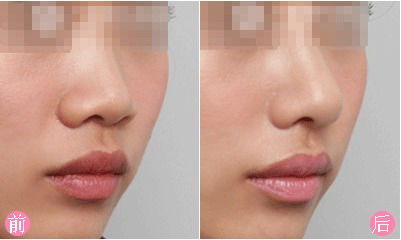 西安假体隆鼻哪家整形医院好,假体隆鼻效果,隆鼻方法