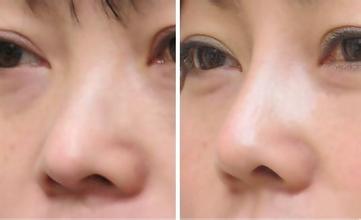 重庆鼻头缩小手术的费用,鼻头缩小手术的价格,鼻头缩小手术的安全性