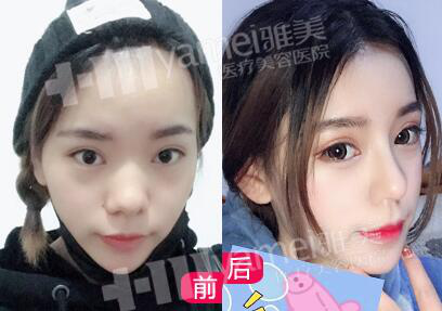 手术-拆线-恢复，30天隆鼻日记分享,鼻综合手术