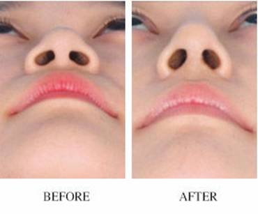 硅胶隆鼻手术效果怎么样