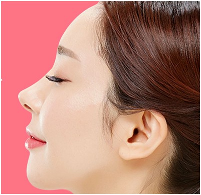 膨体隆鼻手术的缺点