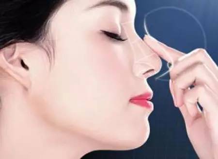 膨体隆鼻手术后的注意事项 
