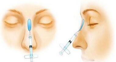 鼻子上打玻尿酸需要多少钱,玻尿酸注射隆鼻多少钱呢,影响玻尿酸注射隆鼻多少钱,玻尿酸注射隆鼻多少钱