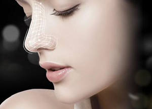 韩式隆鼻失败修复手术