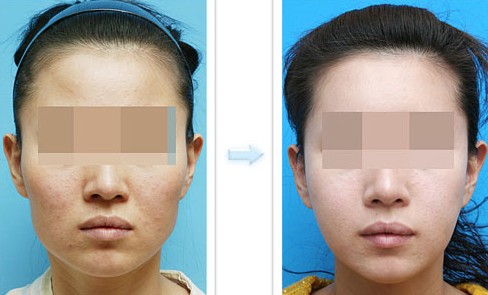 自体脂肪填充鼻唇沟，自体脂肪填充鼻唇沟会发炎吗，自体脂肪填充鼻唇沟恢复期是多久，自体脂肪填充鼻唇沟有副作用吗