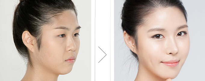 自体软骨隆鼻的恢复期