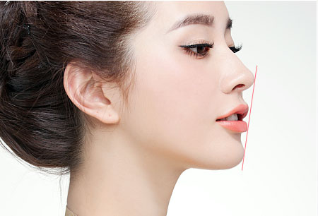 在厦门做进口假体隆鼻