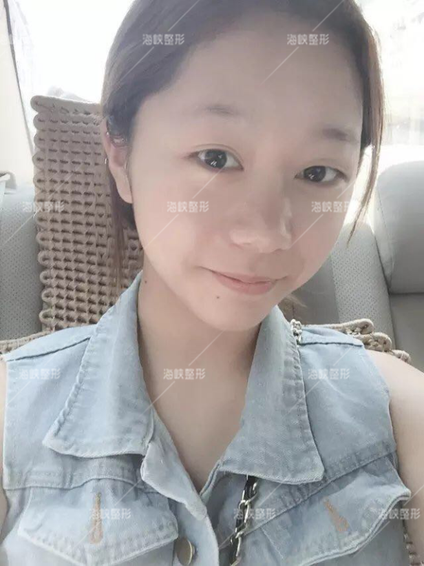 福州海峡整形鼻整形修复