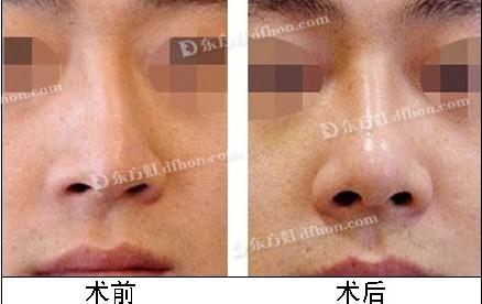 膨体隆鼻多少钱,做膨体隆鼻需要多少钱,硅胶假体隆鼻、膨体材料隆鼻、自体软骨,真皮隆鼻手术