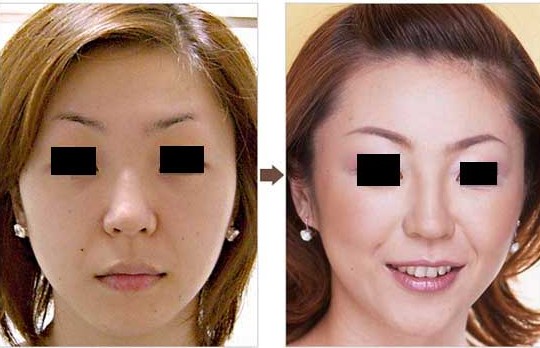 玻尿酸隆鼻前后对比图,玻尿酸注射隆鼻,玻尿酸隆鼻前后的差别