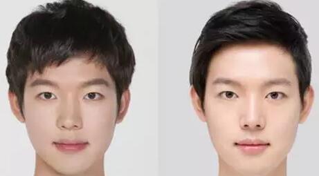 男士做隆鼻手术后需要注意哪些