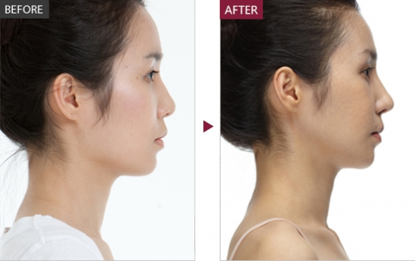 自体脂肪隆鼻,自体脂肪隆鼻有什么优势,自体脂肪隆鼻恢复后