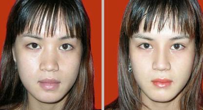 隆鼻手术一般多少钱,隆鼻手术大概要多少钱,假体隆鼻和注射隆鼻