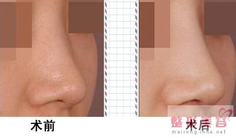 膨体隆鼻和硅胶隆鼻,硅胶隆鼻和膨体隆鼻手术,膨体隆鼻与硅胶隆鼻有什么区别