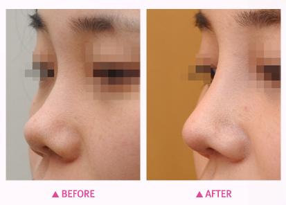 硅胶隆鼻需要多少钱,硅胶隆鼻多少钱,硅胶隆鼻收多少钱,