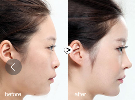 硅胶隆鼻是永久的吗,玻尿酸注射隆鼻,注射隆鼻能维持多久