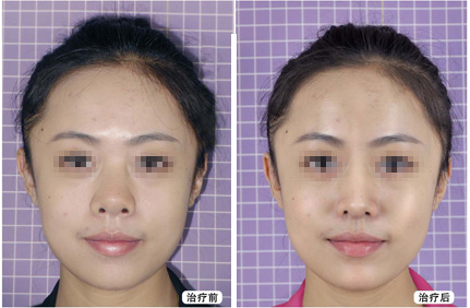 假体隆鼻需要多少钱,假体隆鼻大概要多少钱,影响硅胶假体隆鼻价格