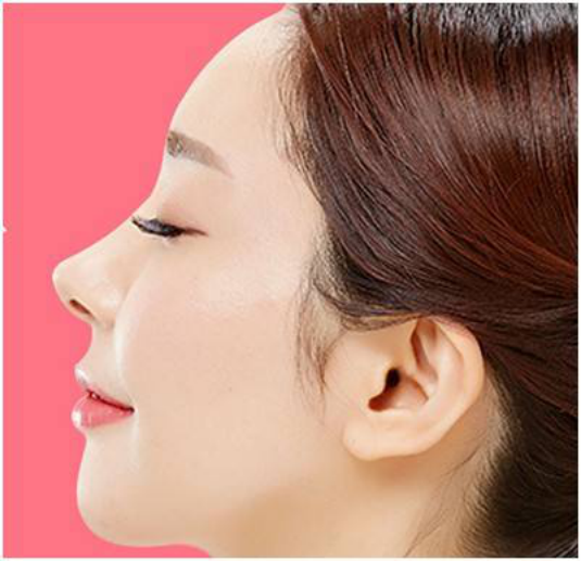隆鼻手术的风险