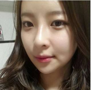 假体隆鼻修复的最佳时间