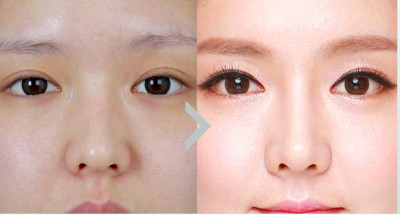 酒糟鼻手术方法