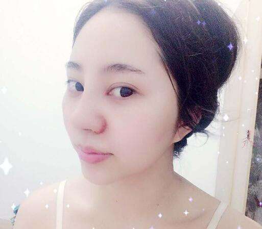 假体隆鼻有没有副作用