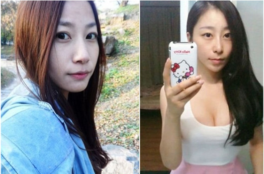 注射隆鼻专门整形医院哪家好，进口玻尿酸注射隆鼻