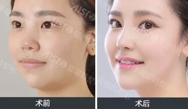 玻尿酸隆鼻需要多少钱,玻尿酸隆鼻价格影响因素,玻尿酸隆鼻多少钱