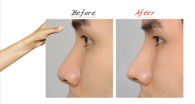 玻尿酸隆鼻多少钱一针