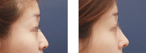 假体隆鼻前后对比照