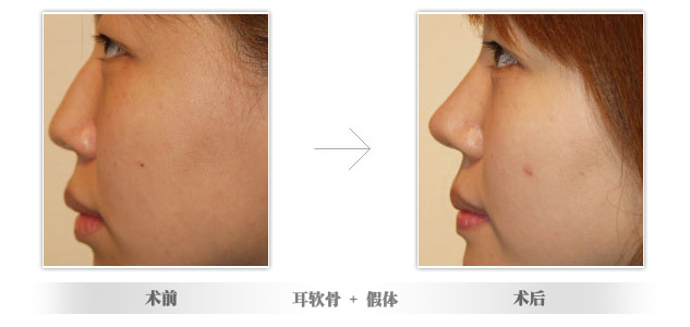自体隆鼻术多少钱