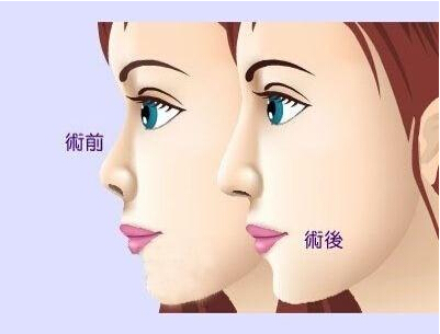 自体软骨隆鼻效果