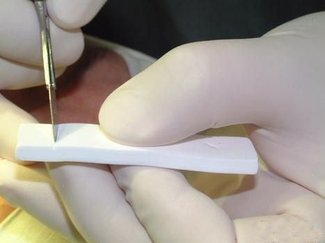 膨体隆鼻的缺点