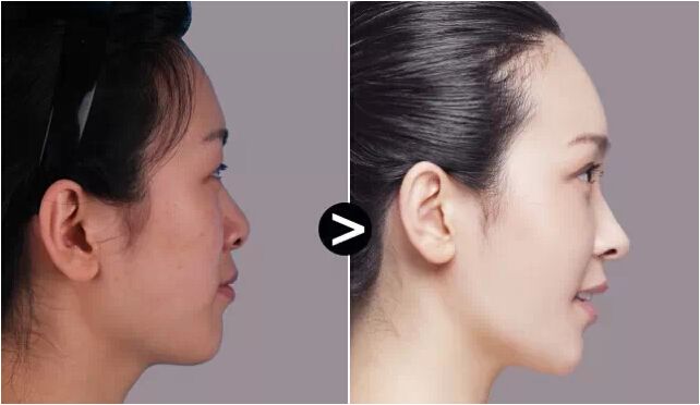 硅胶假体隆鼻多少钱