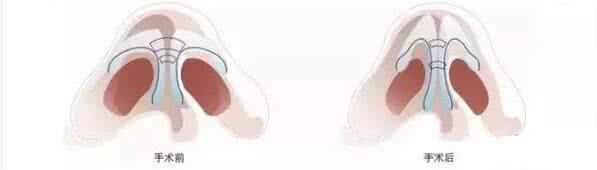 鼻孔缩小