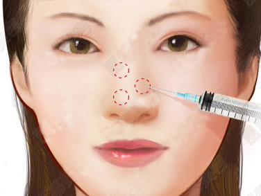 注射隆鼻手术价格