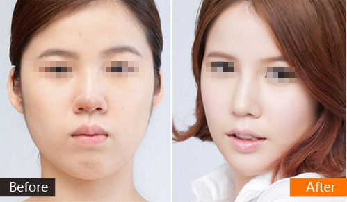 隆鼻失败修复的方法