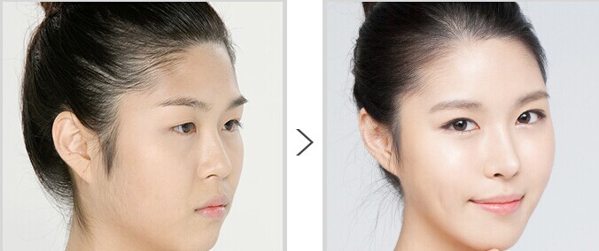 膨体隆鼻手术费用