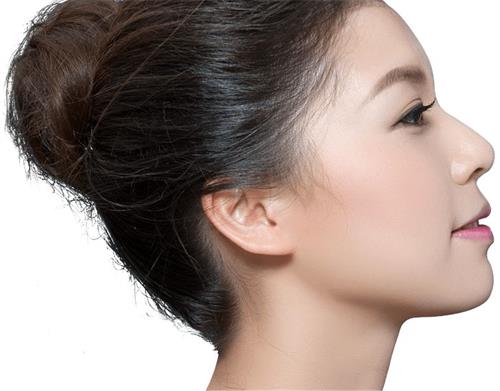 鼻综合整形术前后