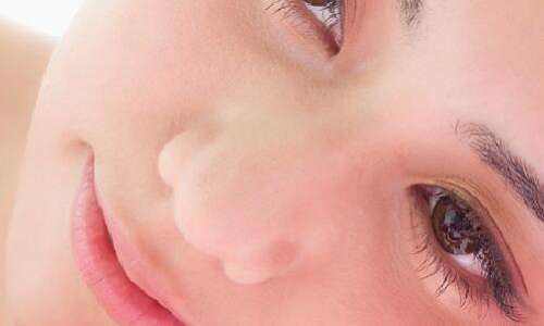 驼峰鼻矫正切口会留疤吗