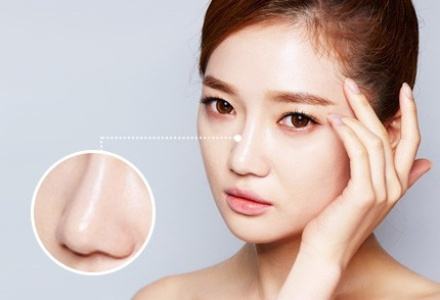 自体软骨隆鼻需要多少钱