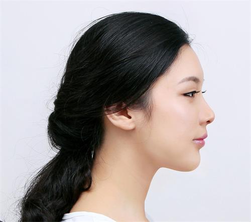 膨体隆鼻手术适合哪些人