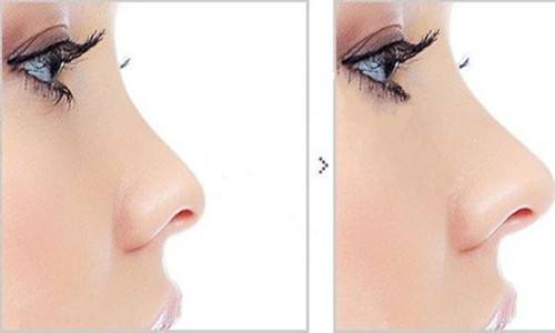 硅胶隆鼻的优势