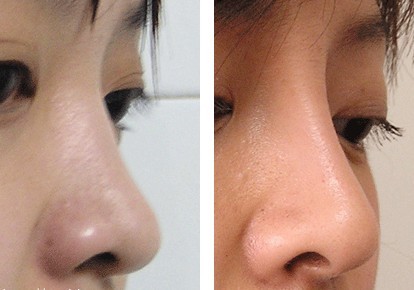 玻尿酸隆鼻的价格是多少