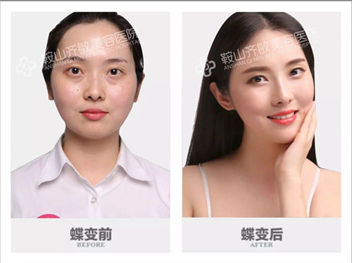 假体隆鼻整容要多少钱