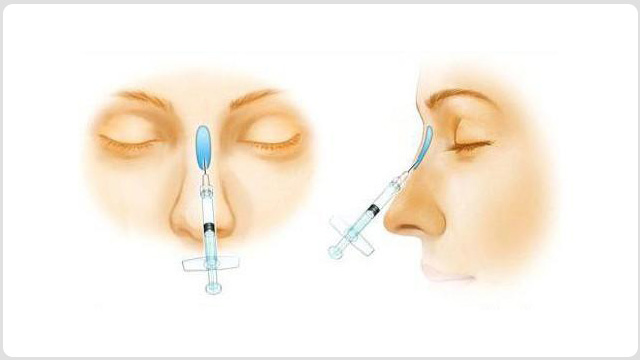 注射隆鼻
