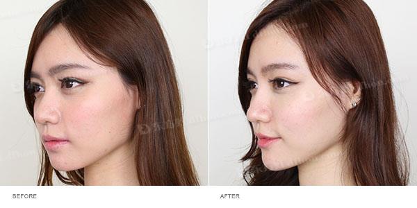 注射隆鼻能保持多久